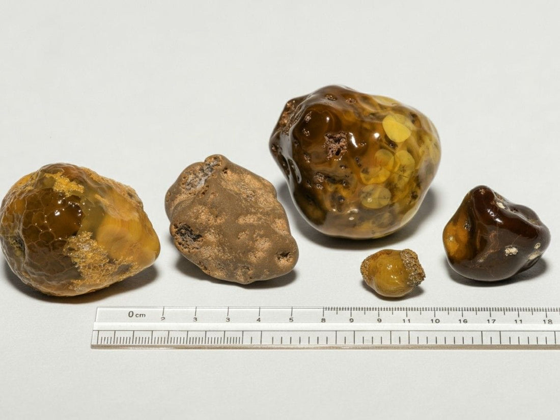 Is a 7 mm Kidney Stone Dangerous?