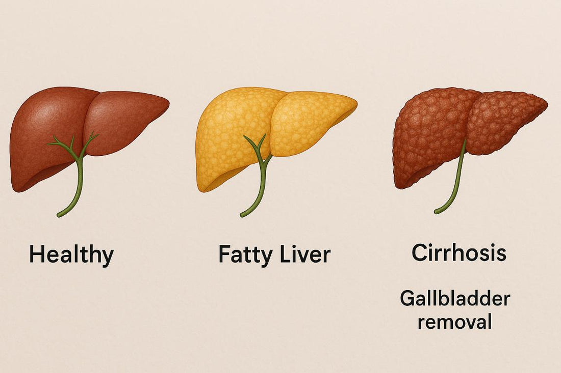 Liver Cirrhosis After Gallbladder Removal: Risks, Symptoms, and Prevention