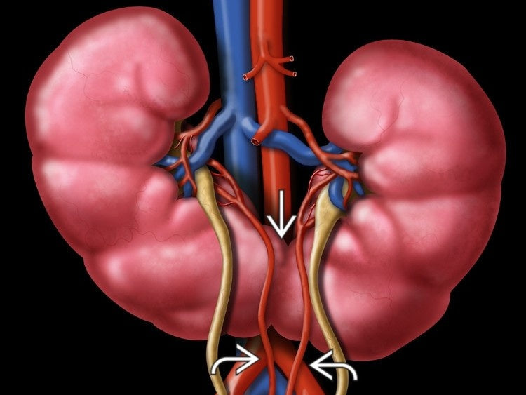 Horseshoe Kidney: What It Means for Your Health