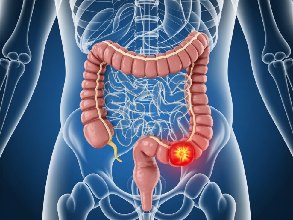 How Bad Is It When Bowel Cancer Has Spread to the Liver and Lungs?