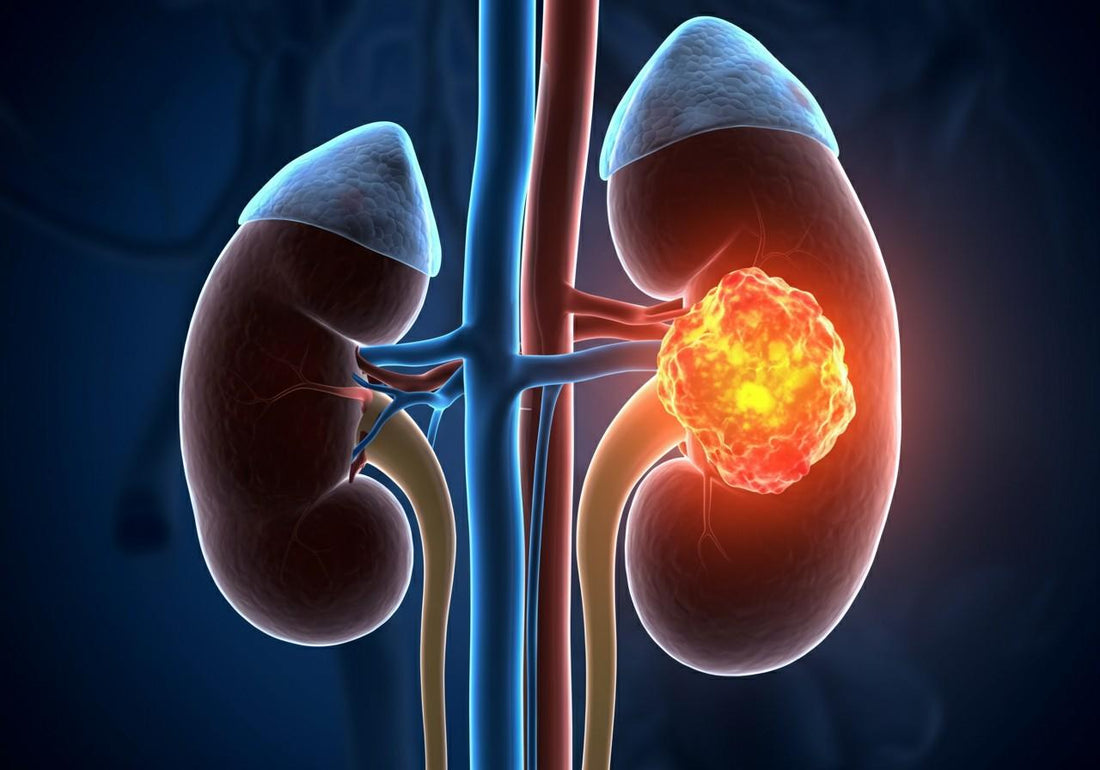 Kidney Cancer Survival Rate by Stage
