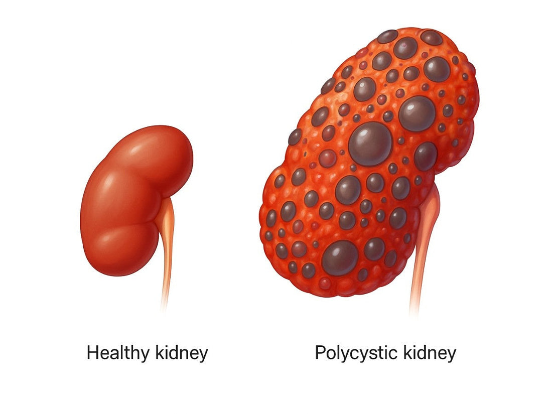 Polycystic Kidney Disease Medication: What’s Available and What’s New?