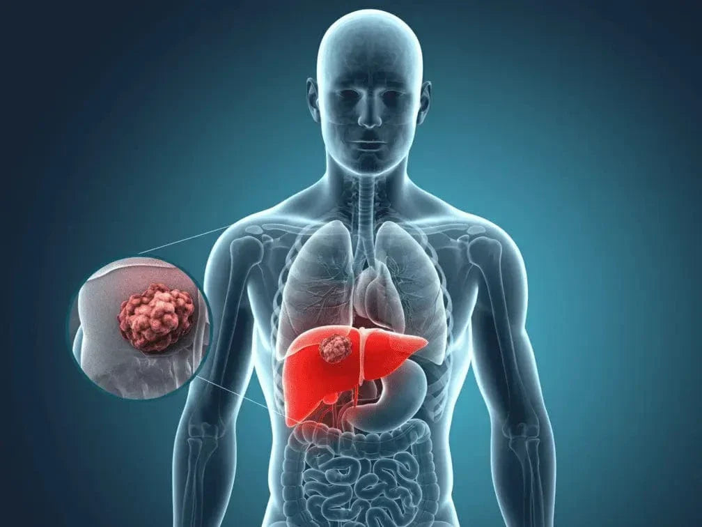 What Percentage of Liver Tumors Are Benign? What Your Scan Might Really Mean