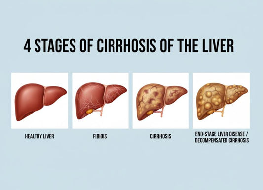 What Are the 4 Stages of Cirrhosis of the Liver? Understanding Progression and Care