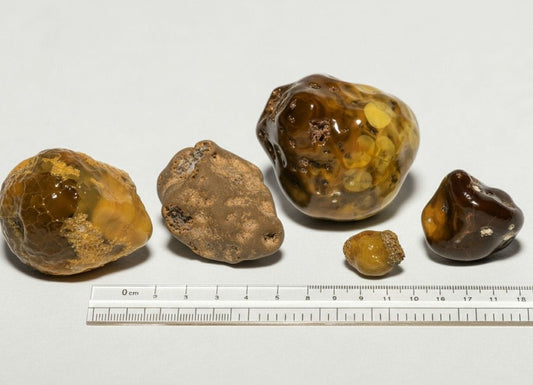 Is a 7 mm Kidney Stone Dangerous?