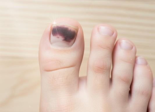 Black Toenail and Diabetes: Causes, Warning Signs, and When to Seek Help