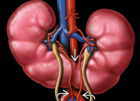 Horseshoe Kidney: What It Means for Your Health