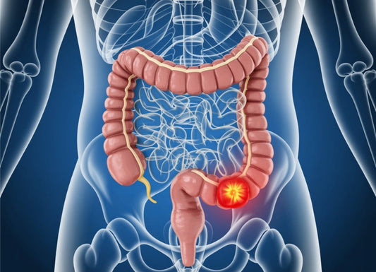 How Bad Is It When Bowel Cancer Has Spread to the Liver and Lungs?