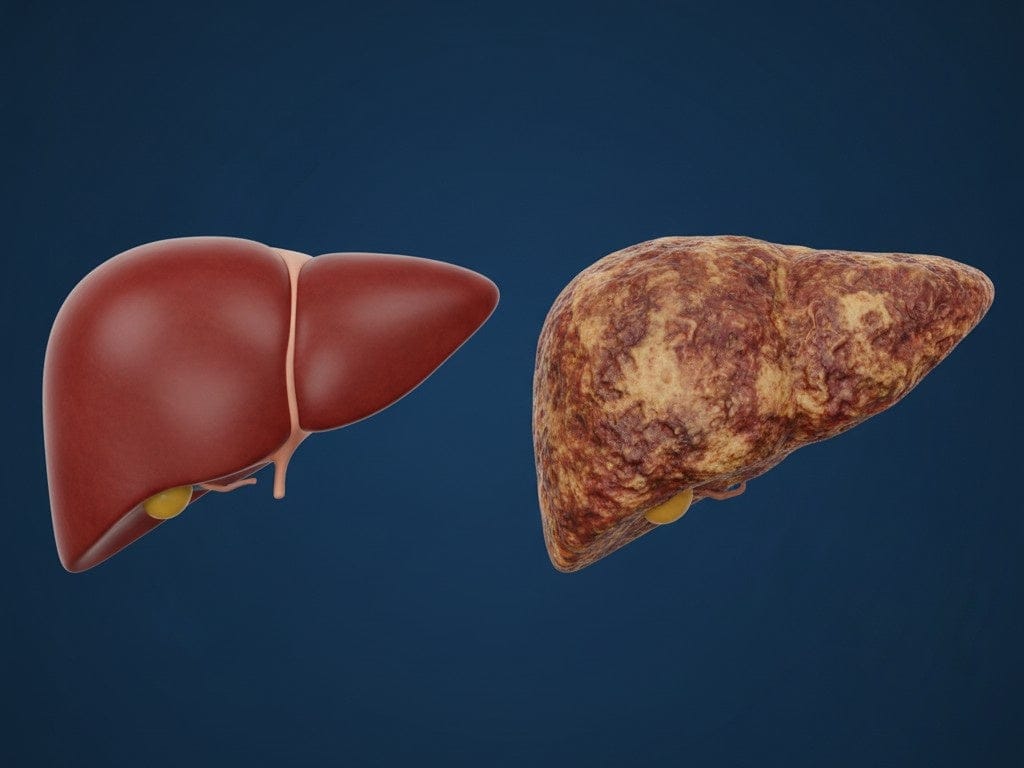 Liver Damage: Causes, Signs, Symptoms, Diagnosis, and Treatment