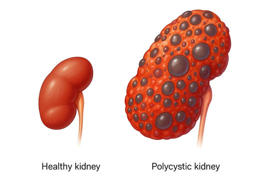 Polycystic Kidney Disease Medication: What’s Available and What’s New?