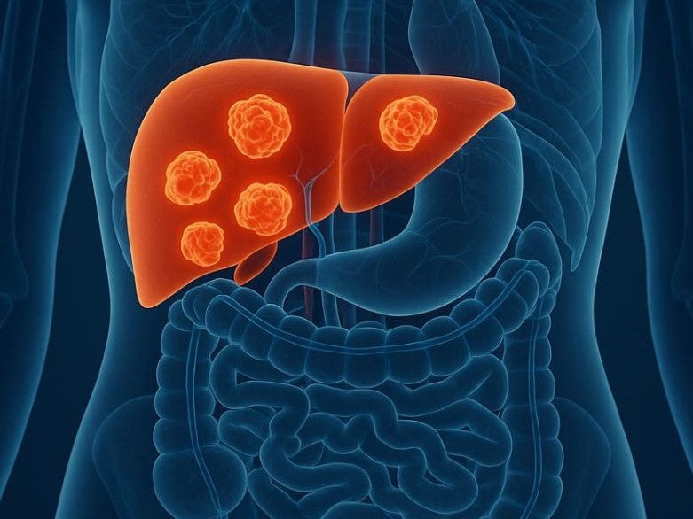 How Fast Do Liver Metastases Grow?