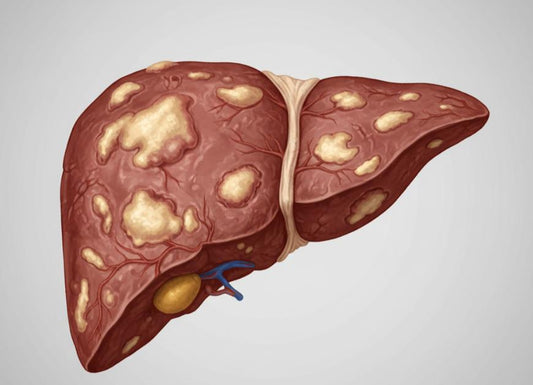 How Long Can You Live With Cirrhosis of the Liver?
