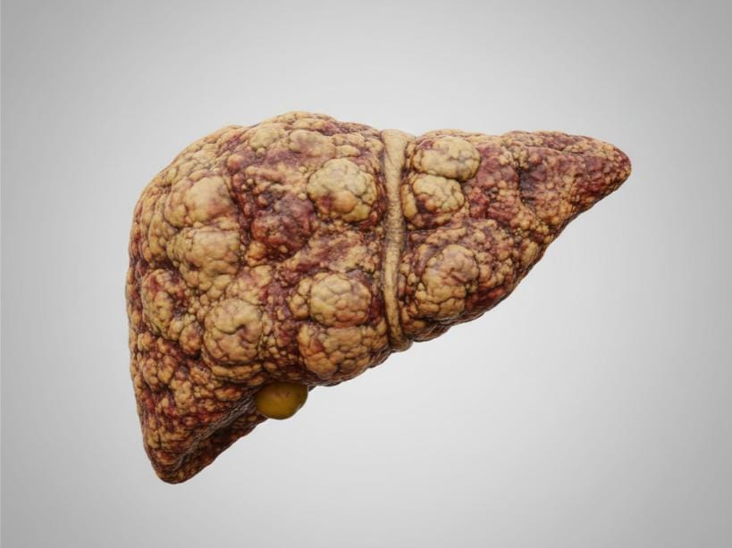 Steatohepatitis: Causes, Symptoms, Diagnosis, and Treatment